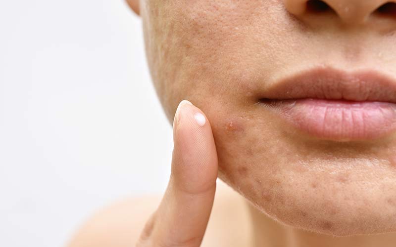 Why Do Teens Get Acne? (And What To Do About Acne for Teens) » TeenWire.org
